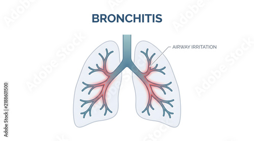 Medical illustration depicting bronchitis and airway inflammation in human lungs