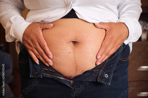 A Bolivian Latina mother holding her stomach, which has stretch marks, with both hands after giving birth - the concept of motherhood
