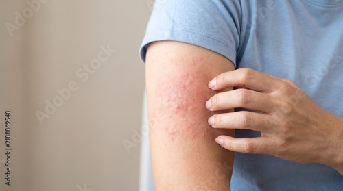 A close-up shot of a person scratching a red, irritated skin rash on their upper arm.
