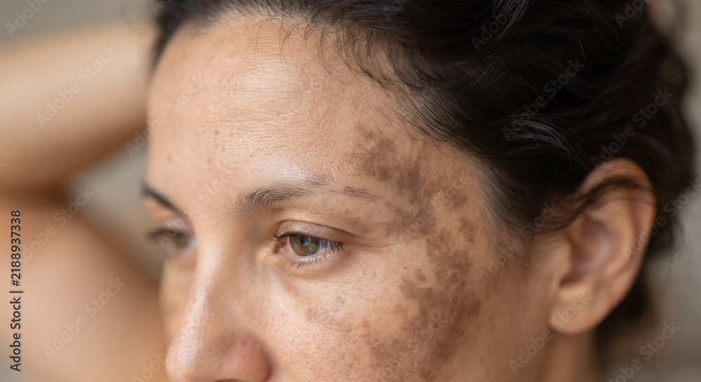 Obraz premium Woman with Melasma: A close-up portrait of a woman's face showing hyperpigmentation, likely melasma, on her cheek and forehead, hinting at concerns about skin health and beauty.