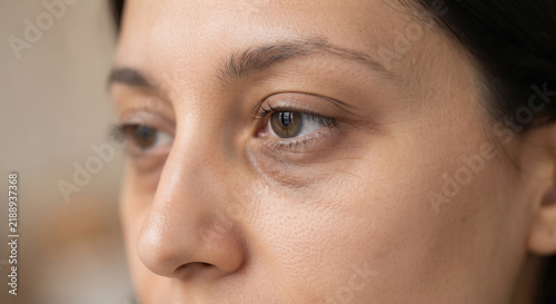 Tired Eyes, Weary Soul: A close-up profile of a woman reveals the tell-tale signs of fatigue with dark circles under her eyes, hinting at sleepless nights and the weight of unspoken worries.