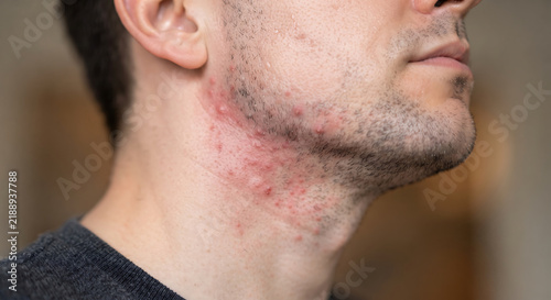 Razor Burn Irritation: Close-up of a man's neck showing red, inflamed skin with visible bumps and irritation, the result of a close shave and an uncomfortable aftermath.