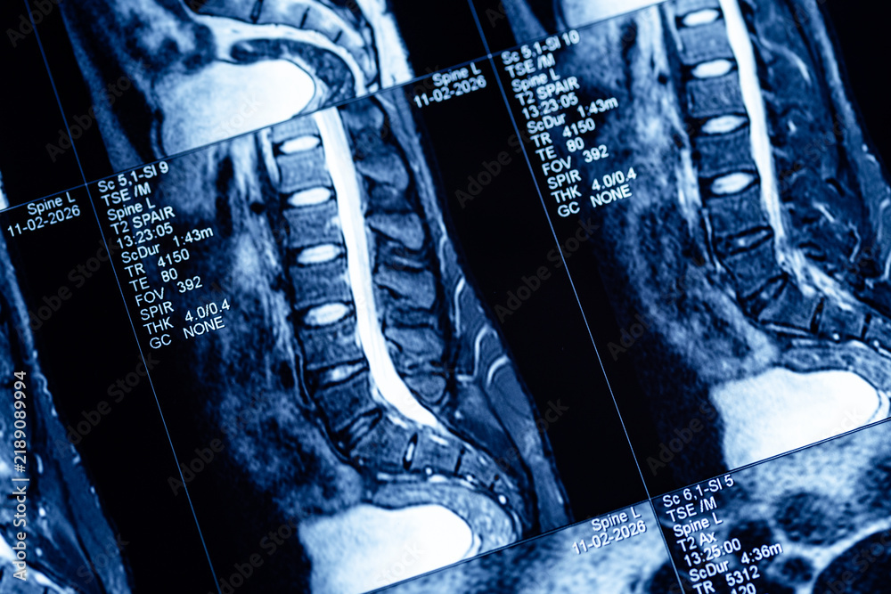Obraz premium High resolution cervical spine mri sagittal scan for medical diagnosis reference and clinical study background