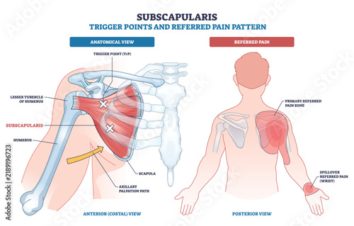 Subscapularis trigger points and referred pain mapped, highlighting subscapularis muscle, scapula, and shoulder pain zones with wrist spillover for quick clinical reference. Outline diagram