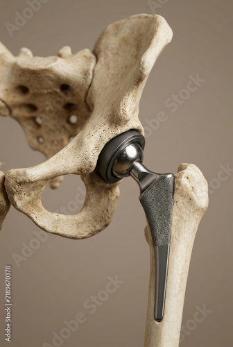 Human pelvis and femur bone fitted with a metallic total hip replacement implant. Detailed medical illustration of joint replacement surgery and titanium prosthesis on beige background. Generative AI.