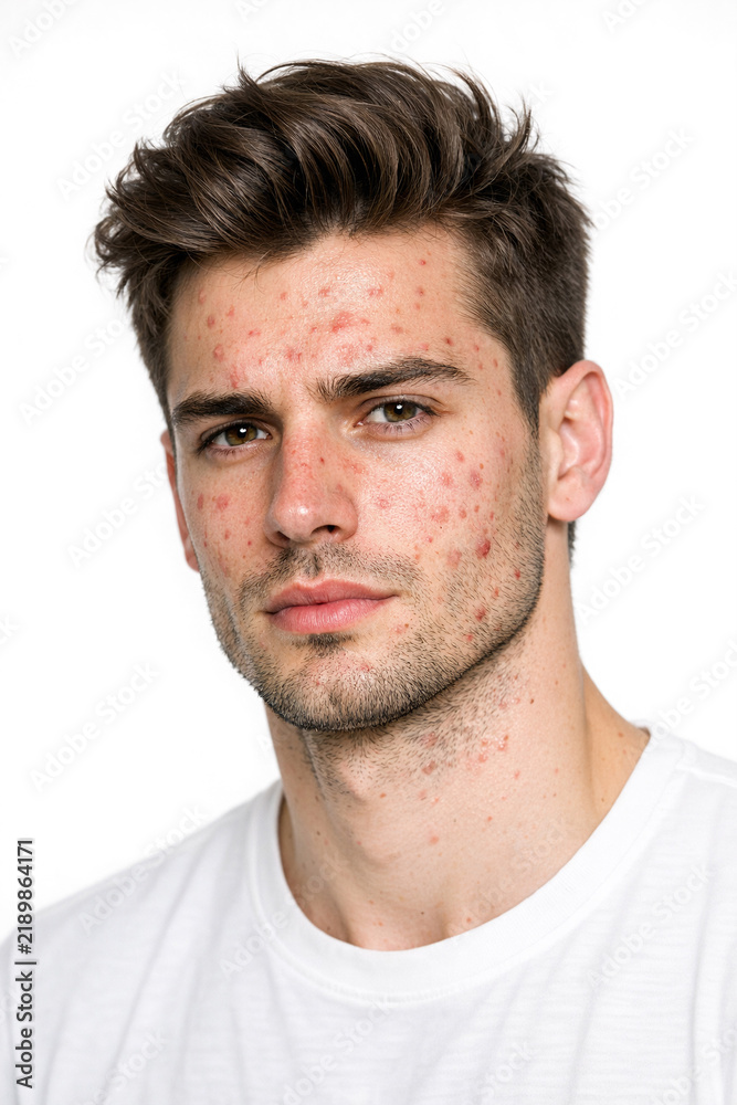 Obraz premium Portrait of young man with acne