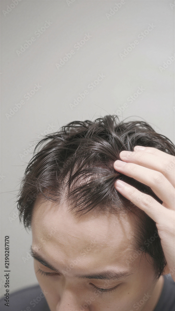 Fototapeta premium Desperate Japanese Young man looking at severe hair loss with disappointed expression, Copy space on the top, Diagonal Aerial view, Vertical image
