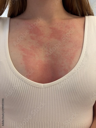 Young Woman with Red Irritated Skin Rash Across Chest, Possible Allergic Reaction, Dermatitis or Sensitive Skin Problem