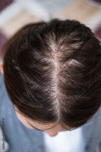Cuadro en lienzo Top of the head of young Asian woman after facing hair loss problem