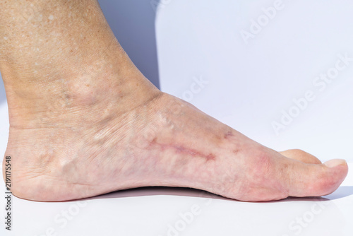 Bild auf Leinwand Close-up shot of a female foot that has undergone complex surgery to correct a b