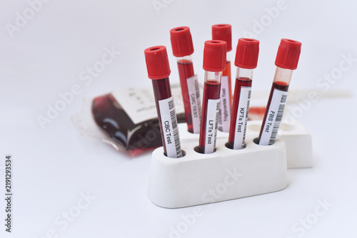 blood tube  are labeled for various medical tests, including CBC, lipid profile, kidney function, and blood chemistry. Suitable for healthcare,  diagnostics, laboratory, blood testing, pathology.