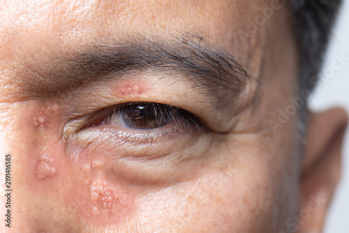 Konstfotografi Shingles, Zoster or Herpes Zoster symptoms on face and eyeis a medical emergency