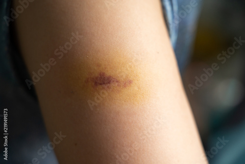 Bild auf Leinwand Bruise injury found on the female arm