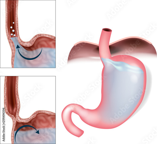 Fotografie Gastroesophageal Reflux Disease GERD and Acid Reflux Medical Illustration