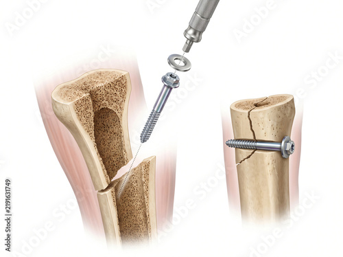 Oblique Bone Fracture Compression Lag Screw Fixation With Washer And Driver Tool Diagram