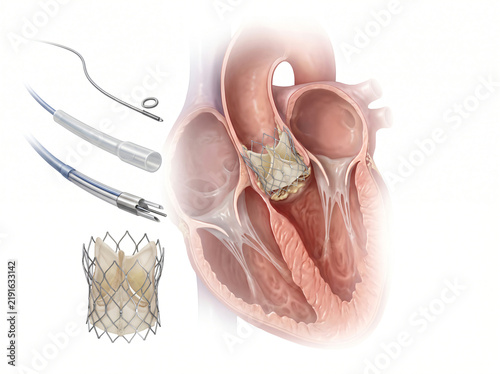 Transcatheter Aortic Valve Implantation TAVI In Heart With Delivery Catheter System Diagram