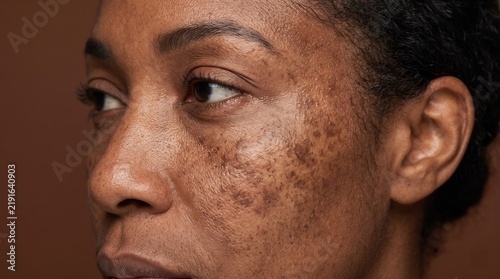 Profile of African American female face showing extensive melasma and sun damage
