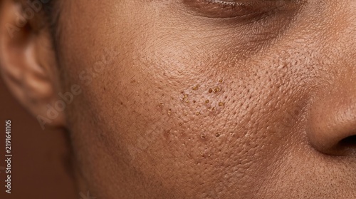 Extreme macro photography of enlarged pores and congested skin on African American cheek