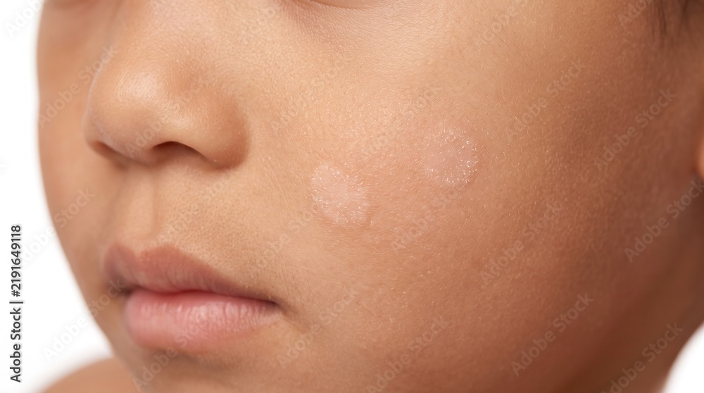 Obraz premium Close up of young child face exhibiting multiple hypopigmented scaly spots characteristic of pityriasis alba skin disorder