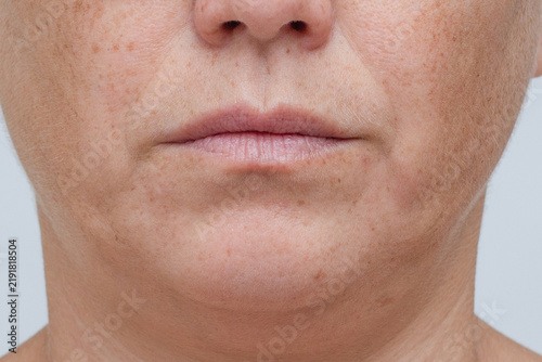 Close up of the lower face with visible jowls and skin texture