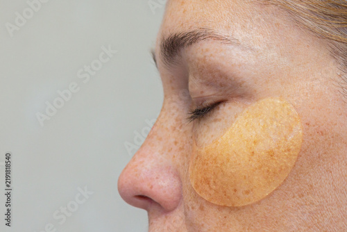 Woman s Profile with a Hydrogel Eye Patch Highlighting Freckled Skin