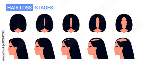 Obraz na plátně Female pattern hair loss stages