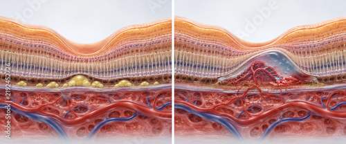 Dry and Wet Macular Degeneration Comparison