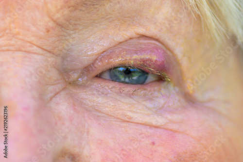 Senior Eye With Visible Stye