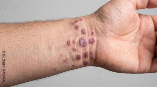 Lichen planus violaceous polygonal papules rash eruption on human inner wrist skin