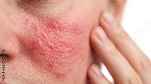 Close-up of a person's face showing skin inflammation, severe redness, and rosacea symptoms on the cheek and nose