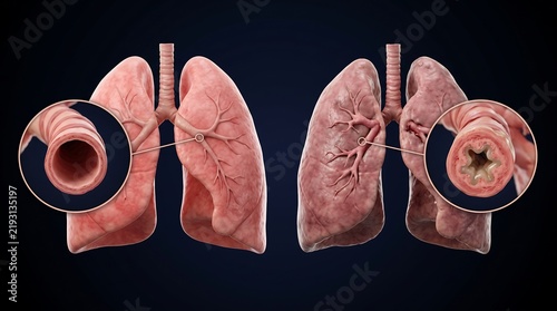 Comparison of healthy and asthmatic human lungs with magnified views of bronchioles showing normal and constricted airways.