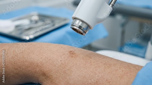 Adult forearm skin dermatology laser treatment in clinical medical setting, blue drape, sterile equipment, focused light, precise healthcare procedure for professional dermatological care