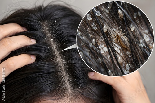 Close up of head lice and nits on human hair with magnified view