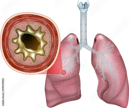 Bild auf Leinwand Detailed medical illustration of human lungs and respiratory system showing bronchitis with a magnified cross section of an inflamed bronchus
