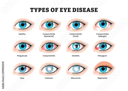 Eye diseases types labeled diagram, educational medical poster design healthcare, bacterial viral allergic conjunctivitis, keratitis, pterygium, cataract, glaucoma. Pinguecula, stye, blepharitis