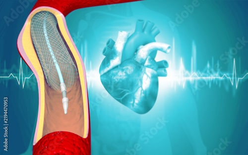 Medical illustration of heart anatomy showing coronary artery angioplasty and balloon stent implantation.
