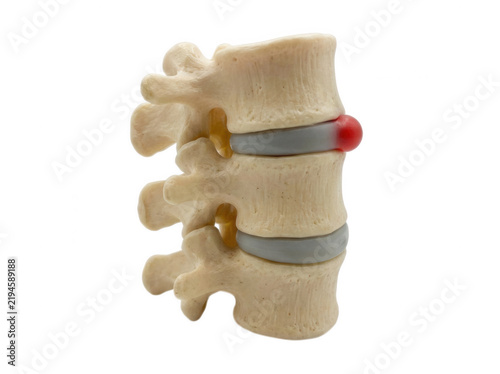Lumbar spine model showing herniated disc pathology isolated on transparent background
