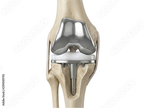 Knee replacement medical implant inside human joint isolated on transparent background for surgery education