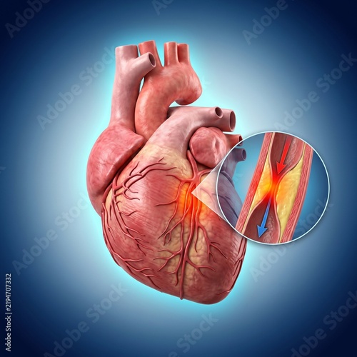 3D Coronary Artery Narrowing Medical Visualization