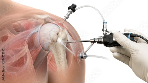 Arthroscopic shoulder surgery showing endoscopic camera and surgical instruments accessing shoulder joint anatomy isolated on white background
