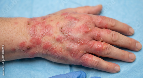 Dermatological Concern: Close-up of a hand afflicted with a severe skin rash, exhibiting redness, inflammation, and irritation.