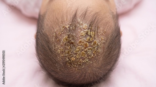 Close up of thick yellowish scaly crusts on a baby's scalp, cradle cap or infantile seborrheic dermatitis condition.