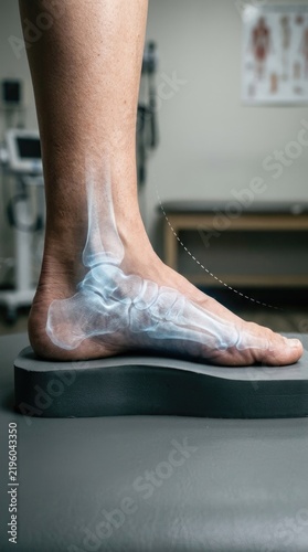 Skeletal ankle scan: flat foot, medical orthopedics, arch support, corrective insole, bone structure, examine joint, heel posture, diagnostic therapy.