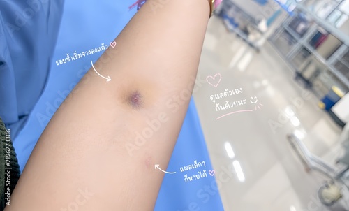 Konstfotografi Close up of arm with bruise and needle mark after blood donation or test in hospital background