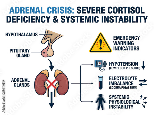 Adrenal Crisis Medical Infographic Showing Severe Cortisol Deficiency Pituitary Axis Hypotension and Electrolyte Imbalance Diagram