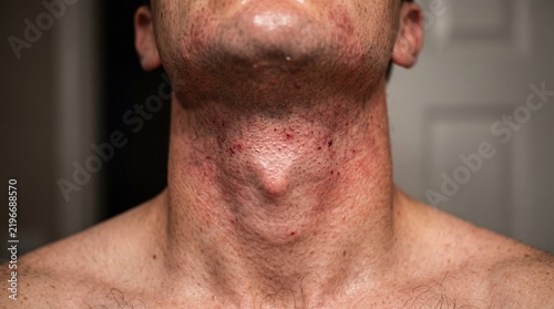 Close-up of man neck with severe razor burn irritation redness and ingrown hair after shaving