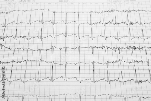 Detailed ECG Heart Rhythm Tracing on Medical Grid Paper. Close-up of an electrocardiogram printout displaying multiple cardiac waveforms and heart rhythm data on medical grid paper.