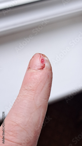 Fotografie Close-up of a human finger with a minor cut and blood visible, showcasing skin d