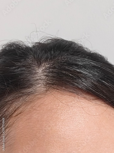 Bild auf Leinwand Female Hair Thinning with Widening Part and Visible Scalp Close Up