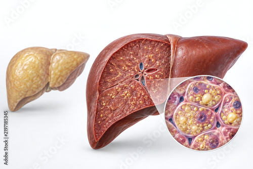 Fatty Liver Cellular Accumulation Comparison